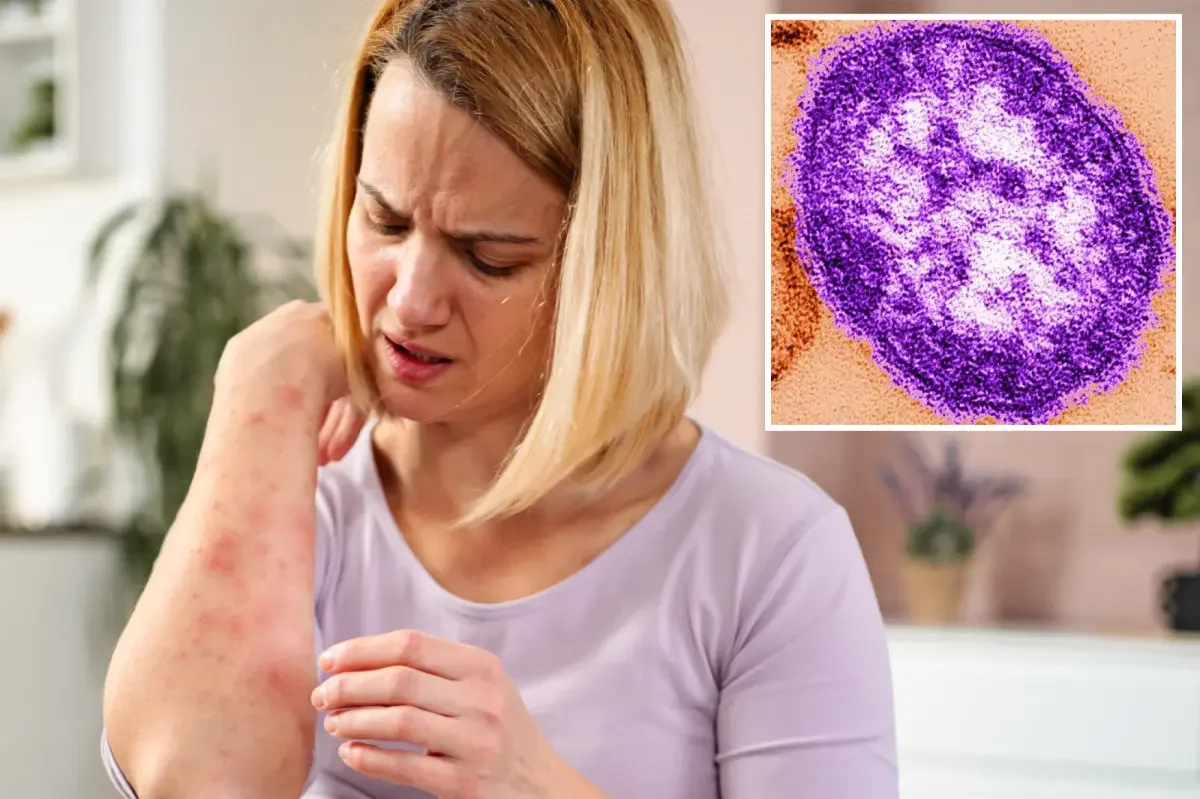 California measles resurges as wastewater signals hidden spread