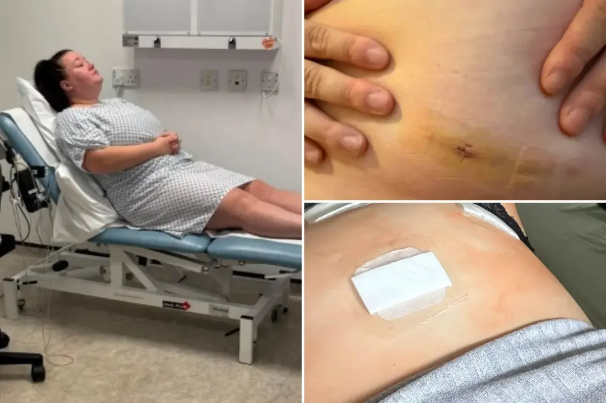 15 years of pain finally explained: endometriosis diagnosed after organ removal