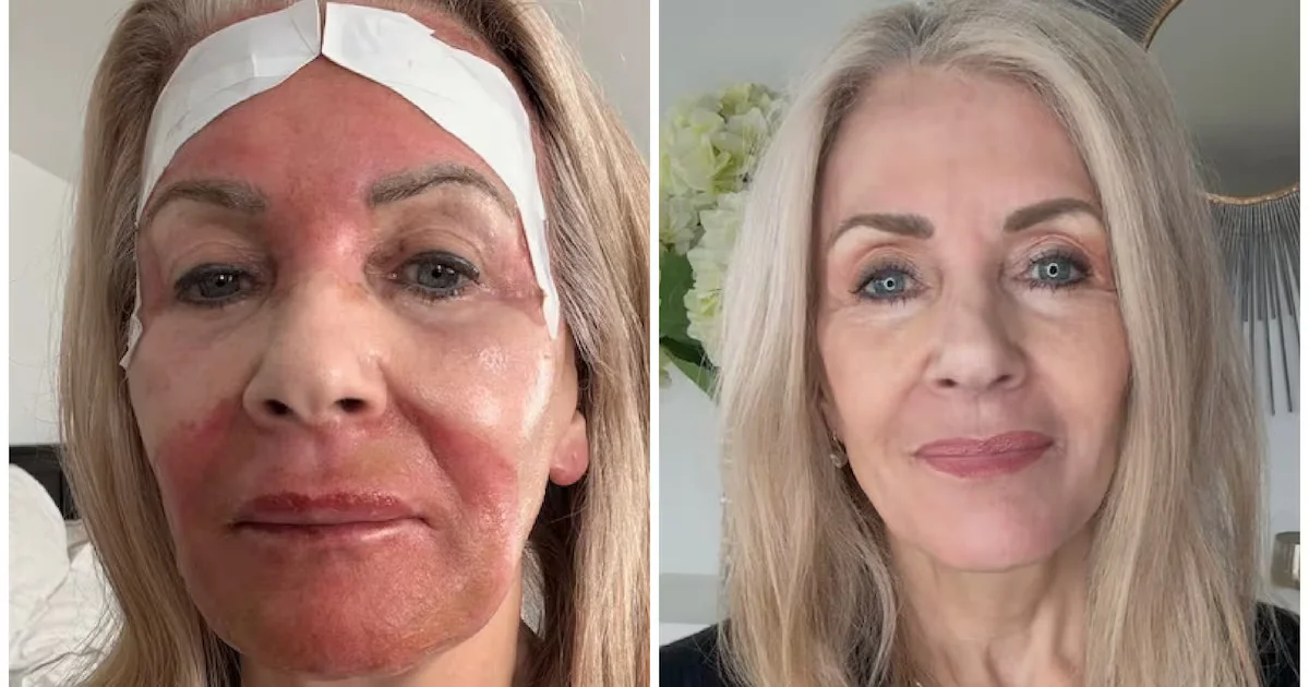 74 and Radiant: Needle-Free Peel Turns Back the Clock