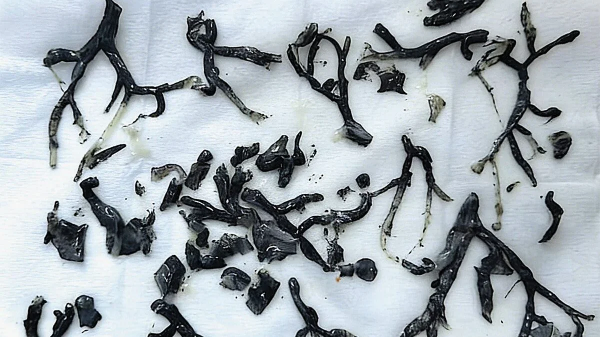 Forest Fire Smoke Can Form Dark Lung Casts, Case Reveals