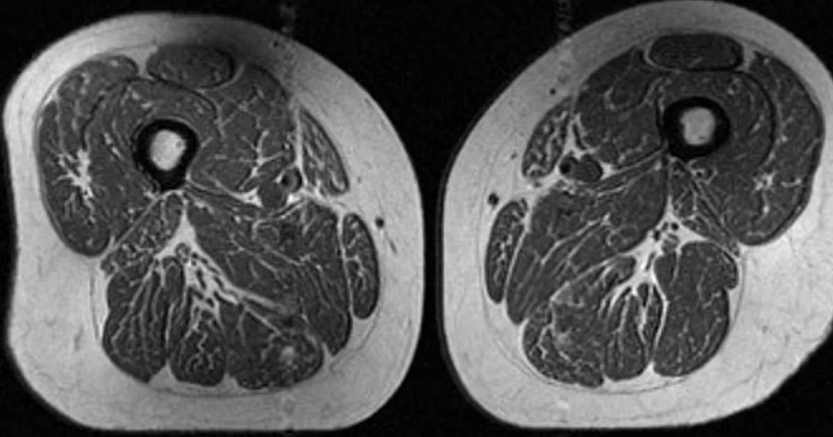 Ultra-processed diets linked to marbled thigh muscles and higher knee OA risk