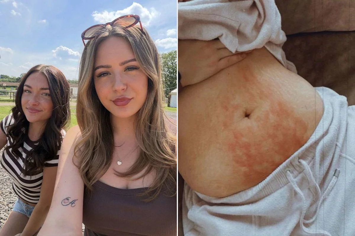 UK Sisters’ Pain Finally Leads to Endometriosis Diagnosis After Years of Dismissal