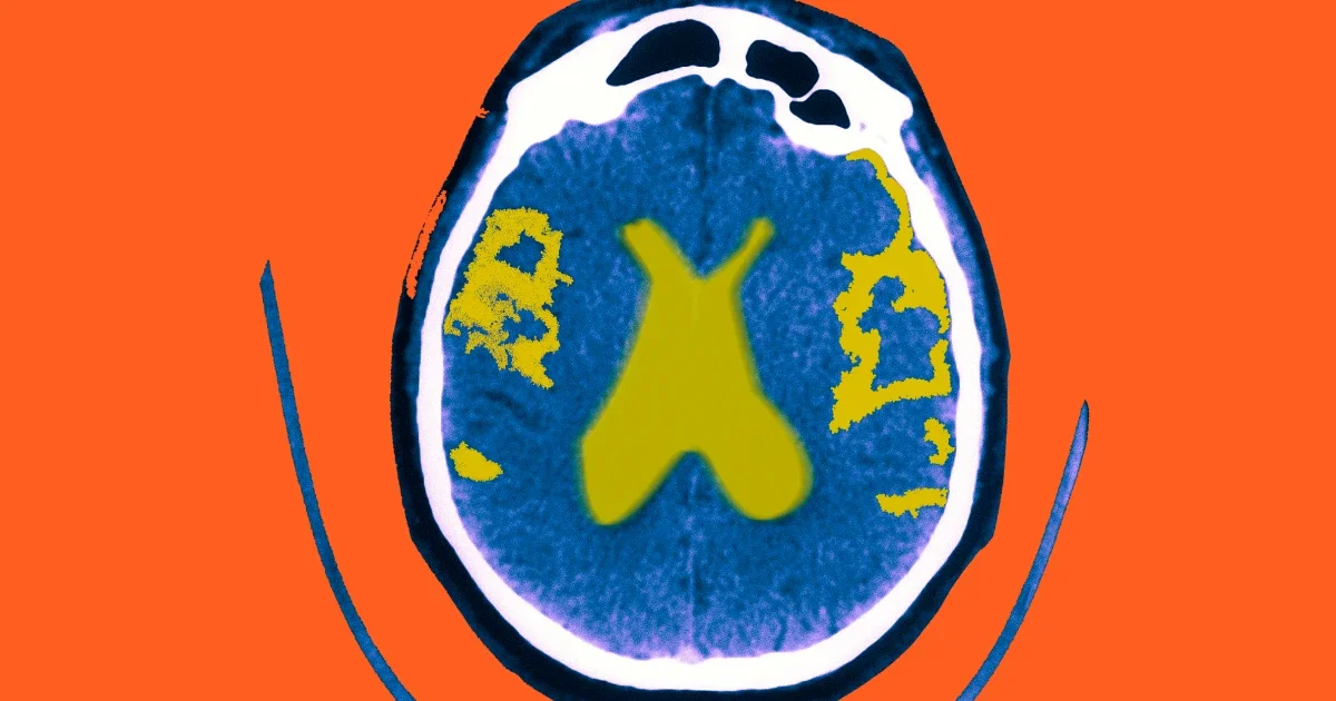 Medicare's Coverage of Alzheimer's Drugs: What You Need to Know