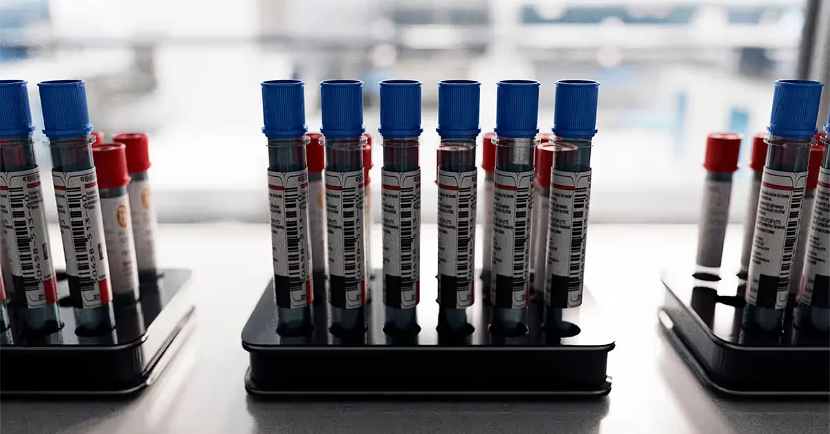 ApoB testing could steer cholesterol care toward fewer heart attacks and strokes