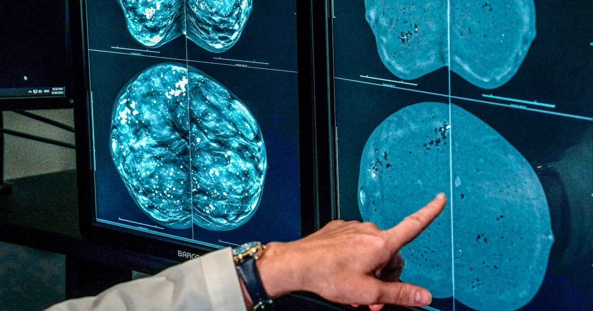 Mammogram timing diverges as experts push toward personalized screening