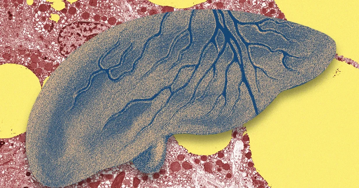 AI Could Catch Fatty Liver Disease Early, Saving Livers and Lives