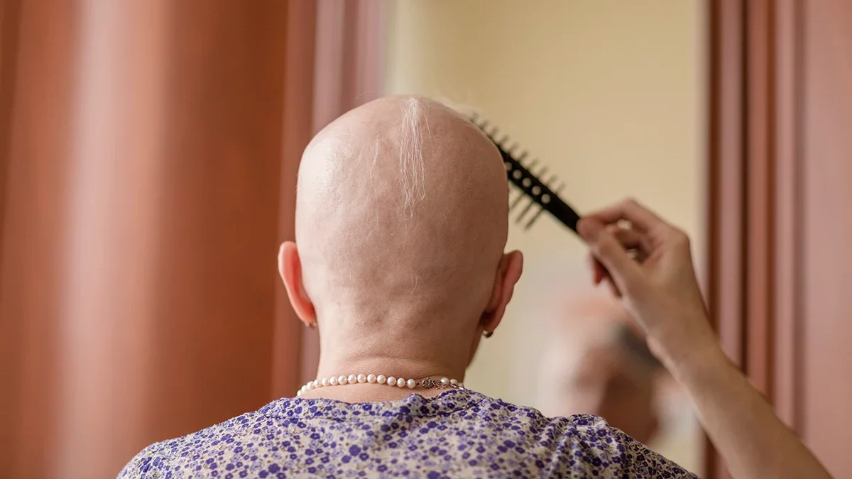 Arthritis Drug Sparks Substantial Hair Growth in Severe Alopecia Areata