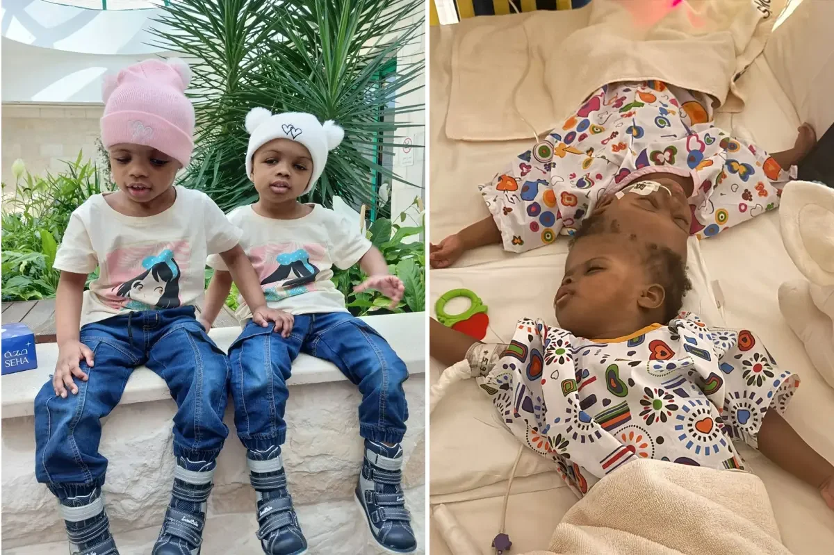 AI-assisted separation frees Nigerian conjoined twins to thrive