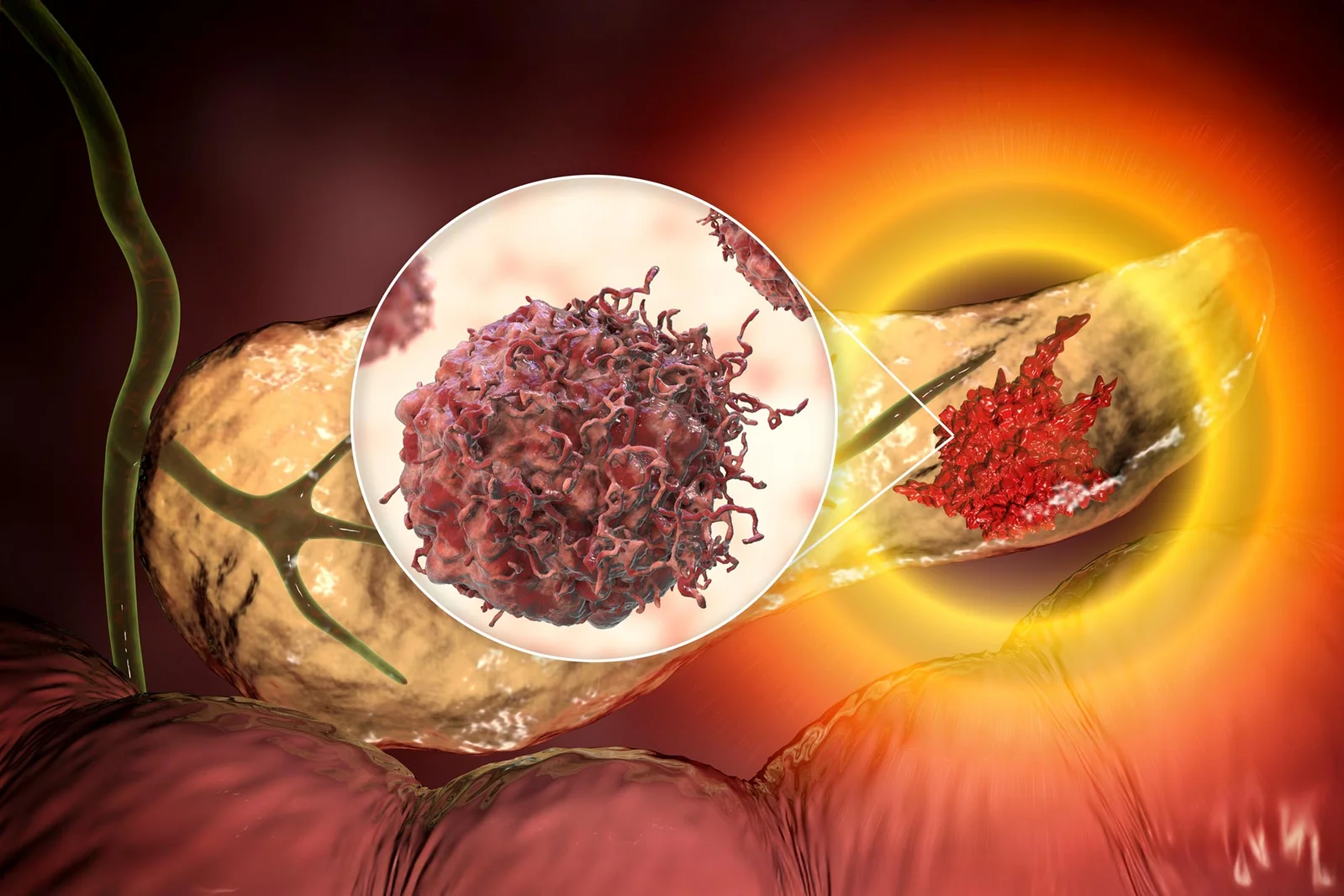 AI spots invisible pancreatic cancer clues years before diagnosis