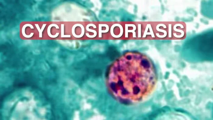 Cyclospora outbreak prompts nationwide warnings, Texas included