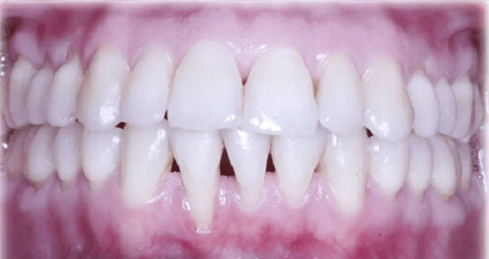 Connective Tissue Graft with Coronally Advanced Flap Restores Root Coverage in Post-Orthodontic Gingival Recession: A Case Report
