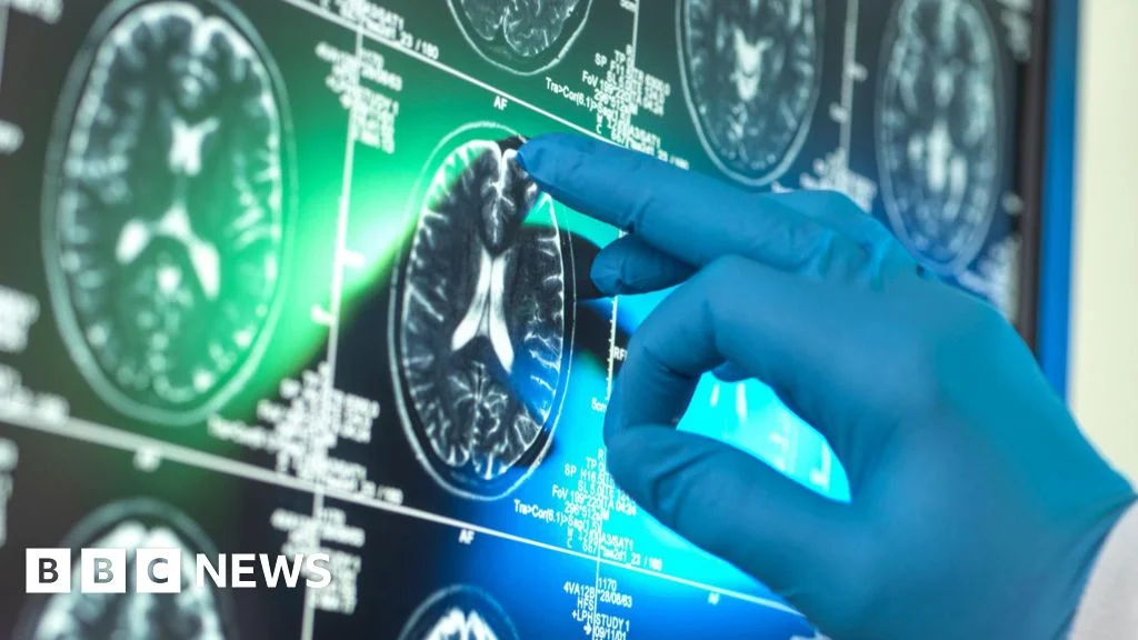 New analysis questions real benefit of amyloid-clearing Alzheimer's drugs