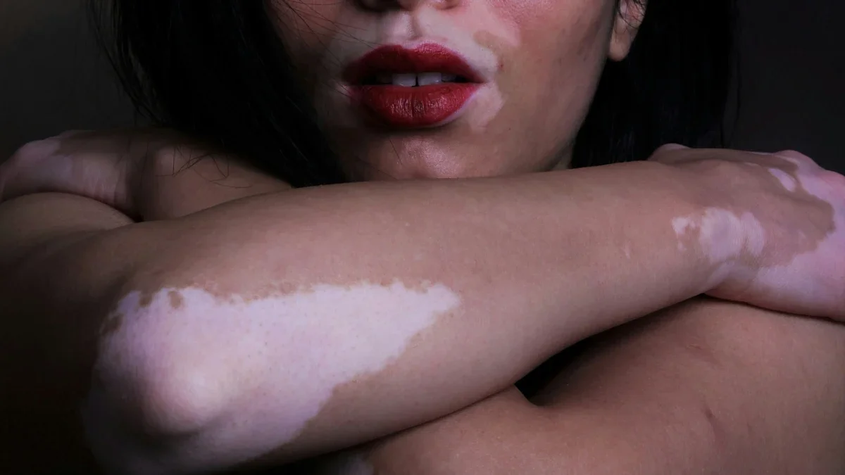 Daily Pill Shows Color Return in Vitiligo Patients (Early Trials)