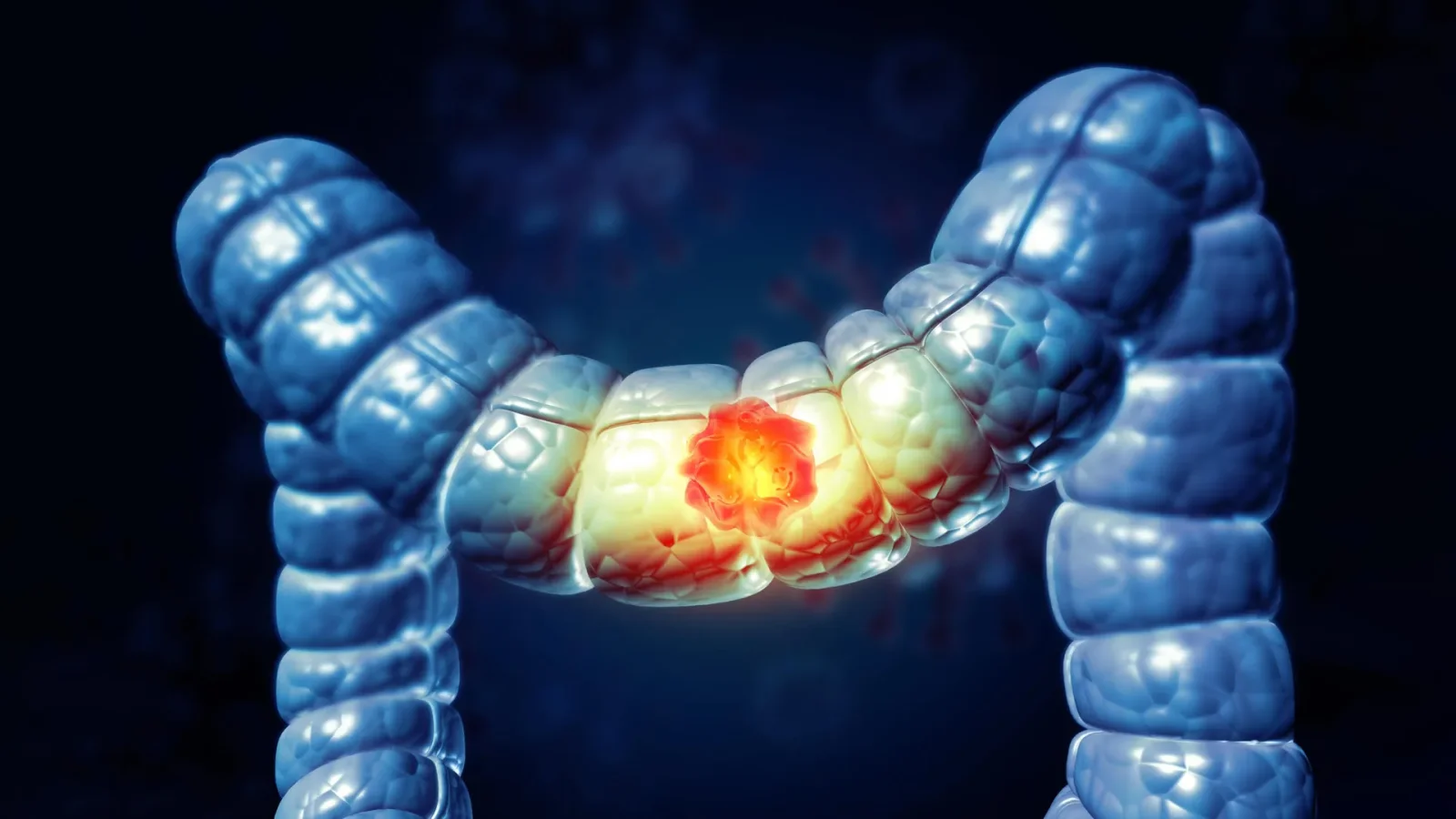Pre-Surgery Immunotherapy Sparks Long-Term Remission in Colorectal Cancer