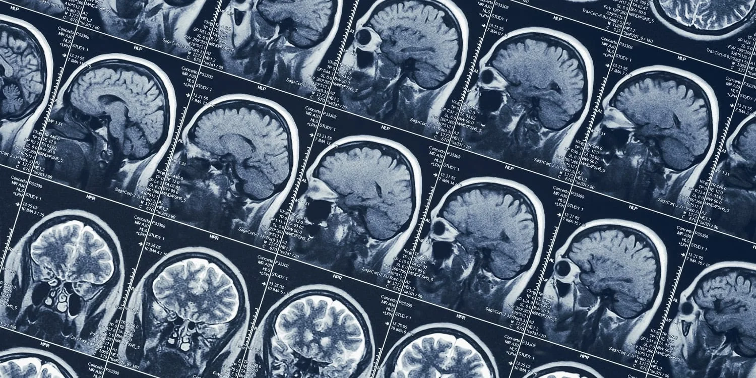 Psychopathy linked to expanded cortical surface in 800 incarcerated men