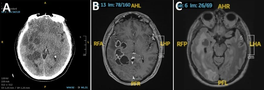 Brain lesion mystery solved: pork tapeworm masquerades as cancer