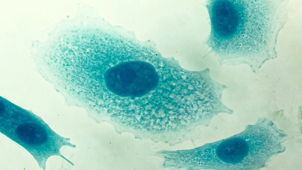 PSA screening may cut prostate cancer deaths, but benefits are modest and conditional