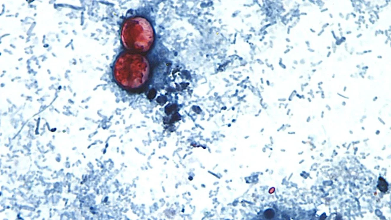 New York’s Cyclospora Outbreak Expands as NY Nears 400 Cases