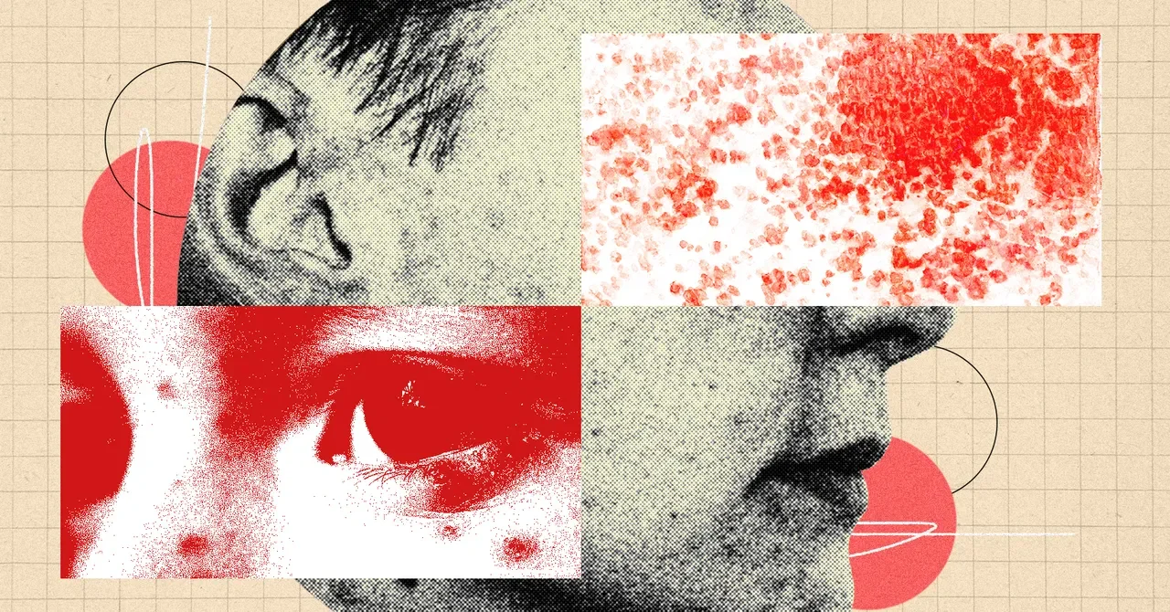 Shingles: A Painful Hidden Risk Doctors Urge Vaccination Against