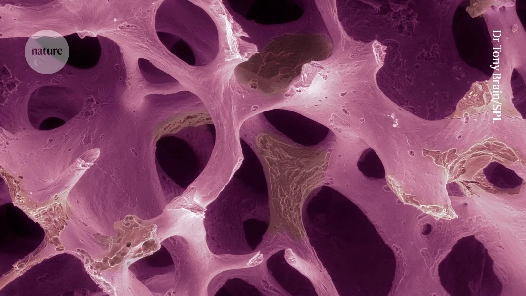 Tweaked marrow cells hint at rebuilding brittle bones in osteoporosis