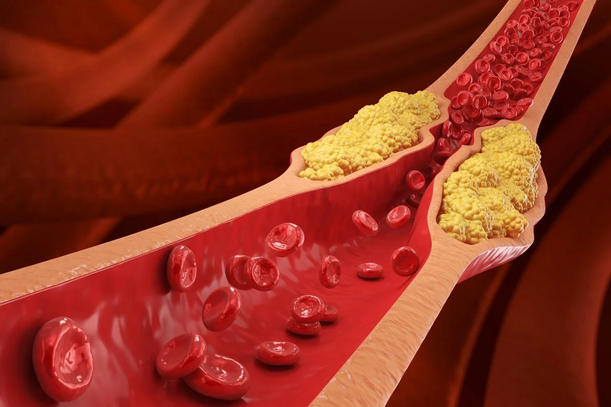 Global LDL Cholesterol Map: Korea Lowest, Austria/Germany Highest, with Asian Rise