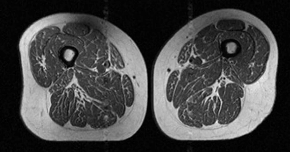 X-ray imagery links ultra-processed foods to fatty muscle changes