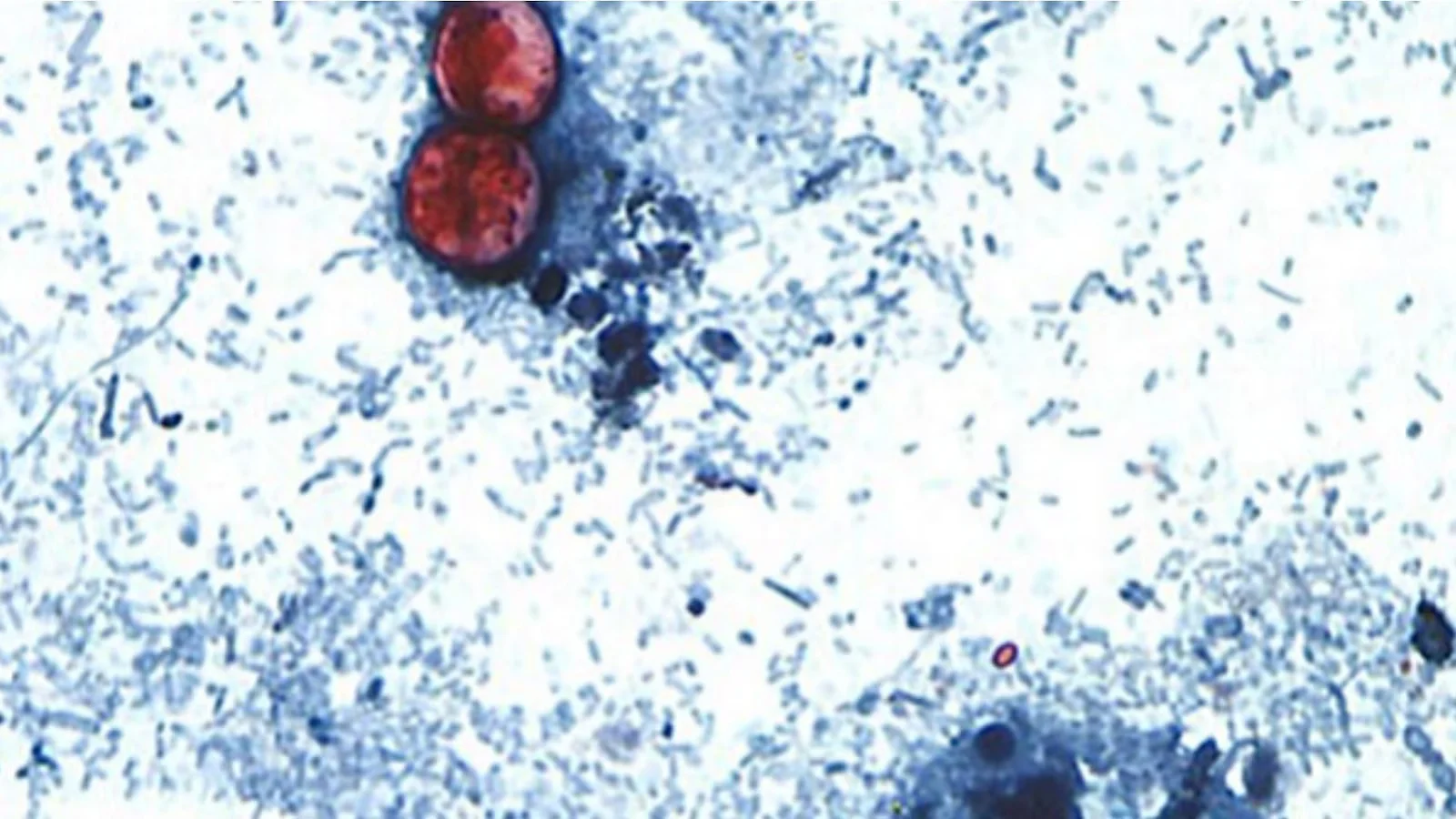 Michigan reports 2,600+ cyclosporiasis cases as hospitalizations rise