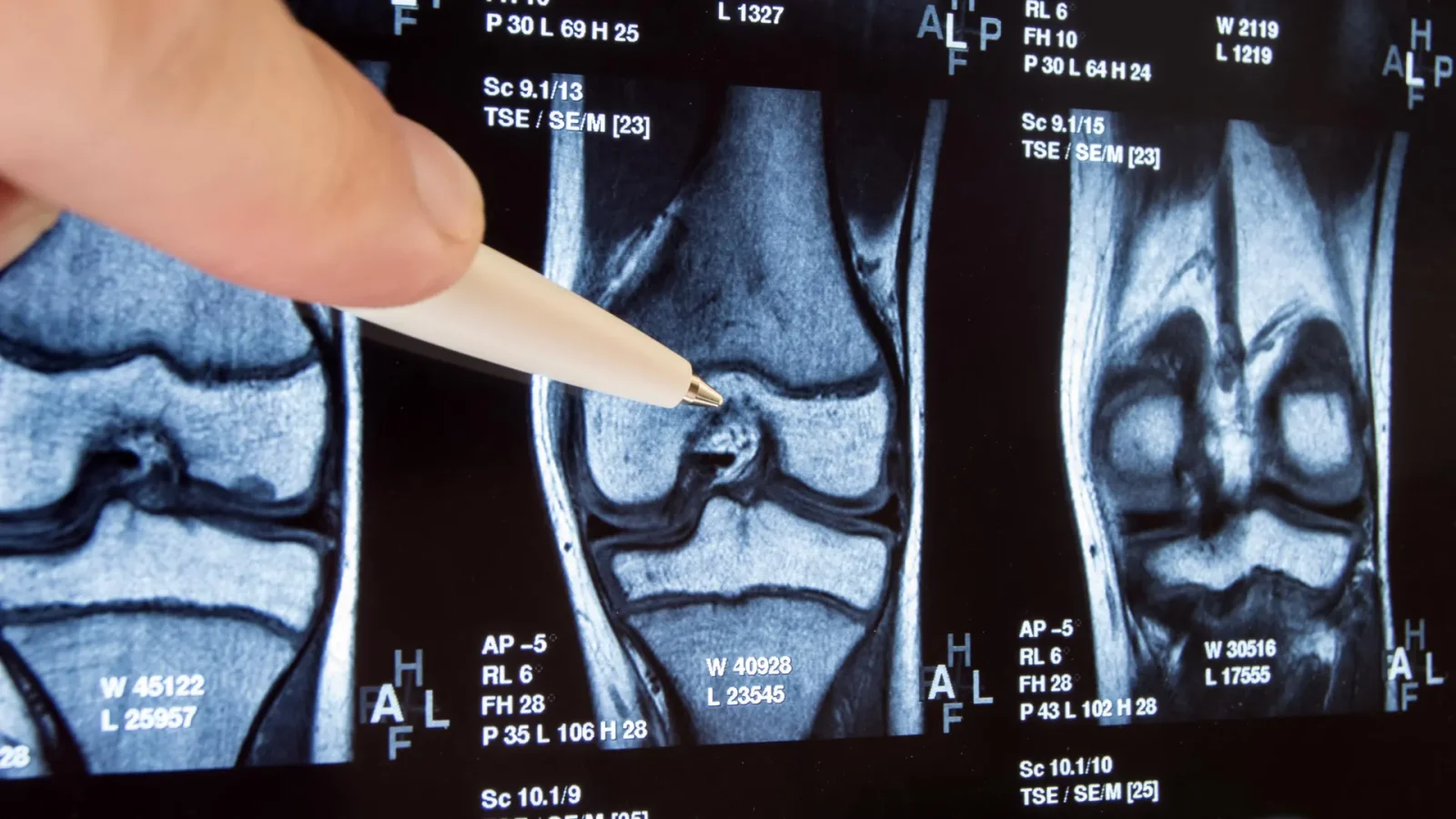10-Year Trial Upends Common Knee Surgery: No Benefit, Potential Harm