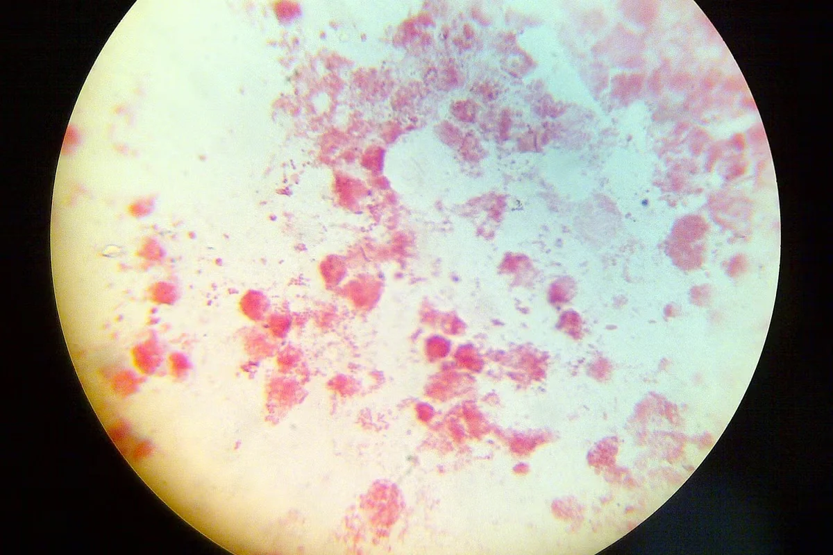 Europe faces record STI surge as testing expands and sexual habits shift