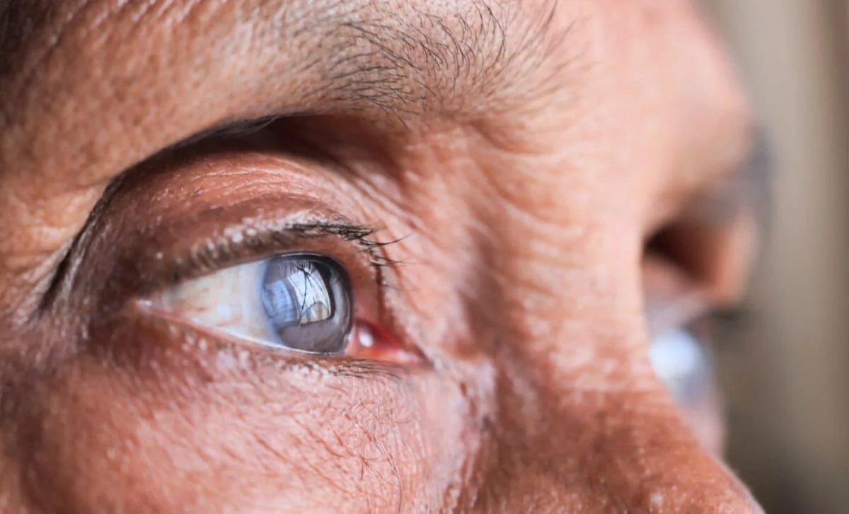High-Dose Eye Supplements Slow AMD, But Not for Everyone