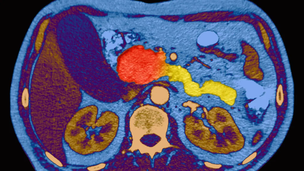 Pancreatic cancer braces for post-daraxonrasib era
