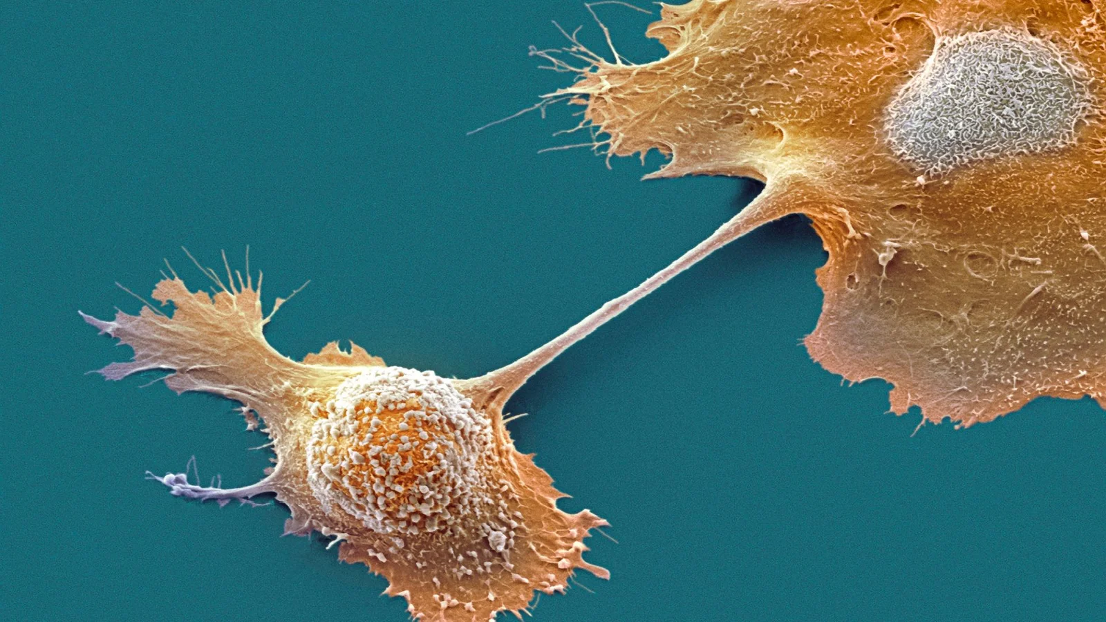 Experimental pancreatic cancer drug doubles one-year survival in trial