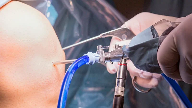 A Decade Later, Knee Arthroscopy Finds No Benefit for Degenerative Meniscal Tears