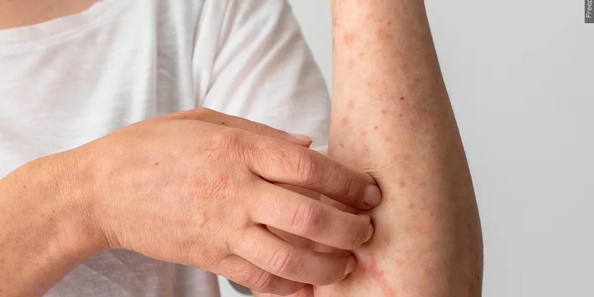 Possible measles exposure prompts health alert at Colorado Springs Chick-fil-A