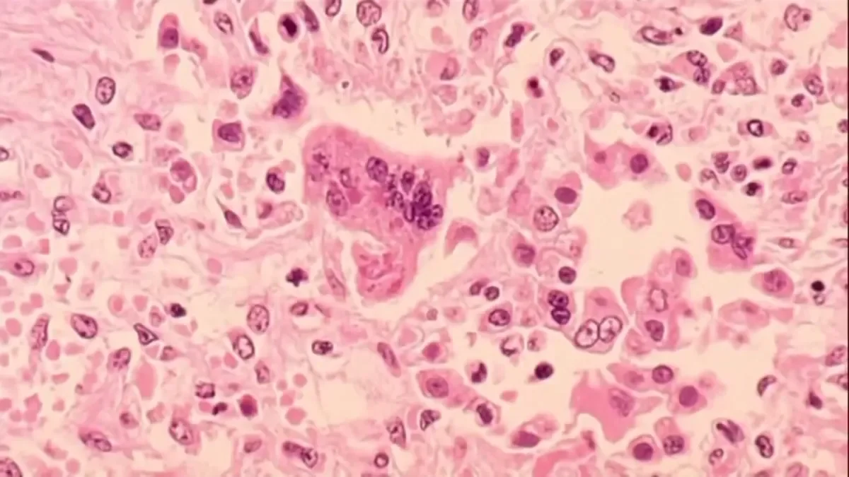 Connecticut Sees Second Measles Case of 2026 in Vaccinated Adult