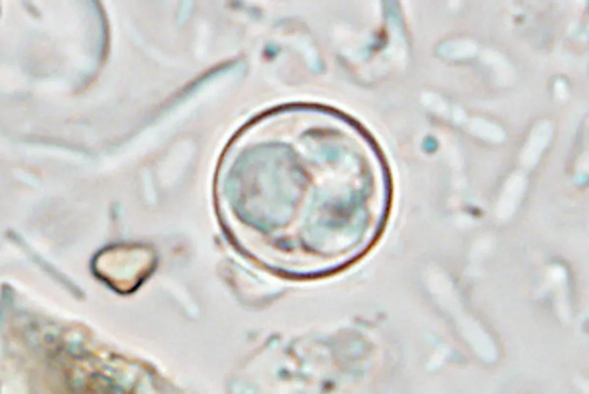 Cyclospora outbreak expands across 17 states with 145 cases