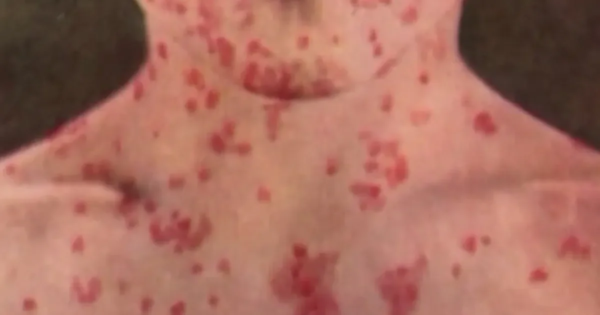 Measles exposure alert linked to SFO and San Jose venues prompts vaccination checks