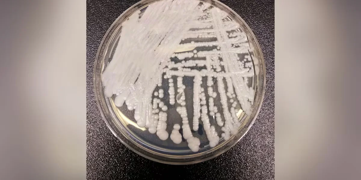 US Faces Widespread Spread of Candida auris Across 26 States