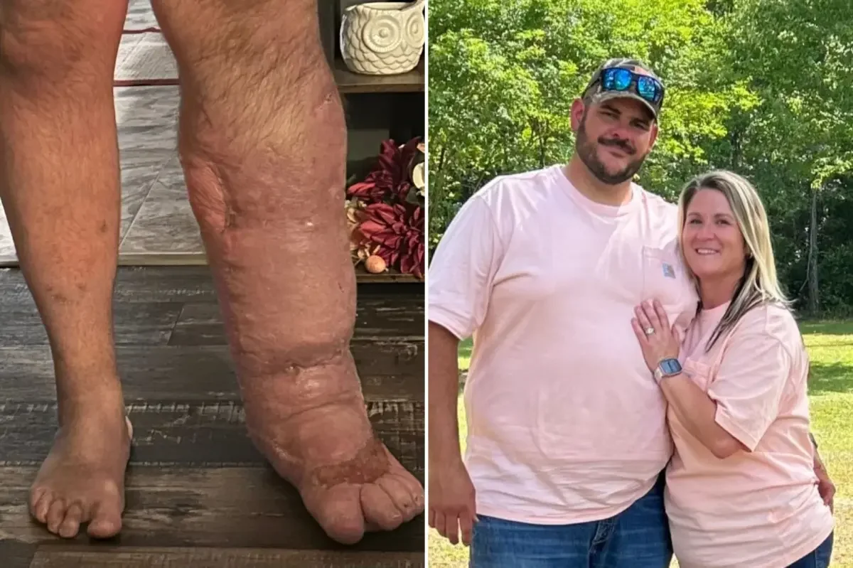 Florida man’s leg swells to eight times its size after Vibrio infection, plan for below-knee amputation