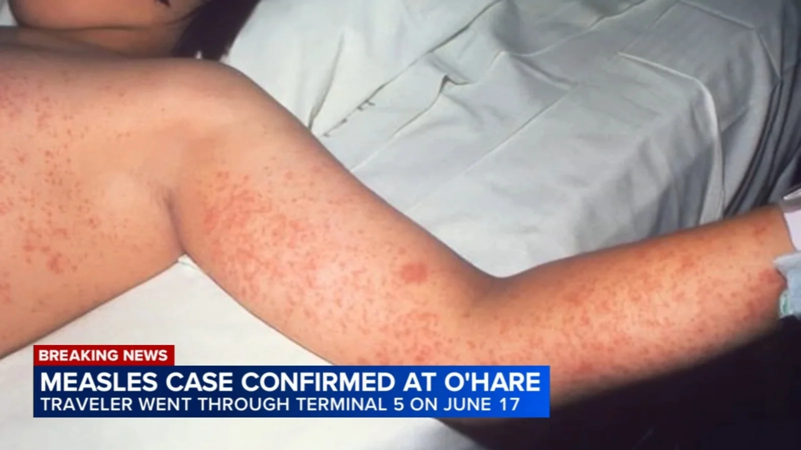 O'Hare measles exposure prompts public health warning