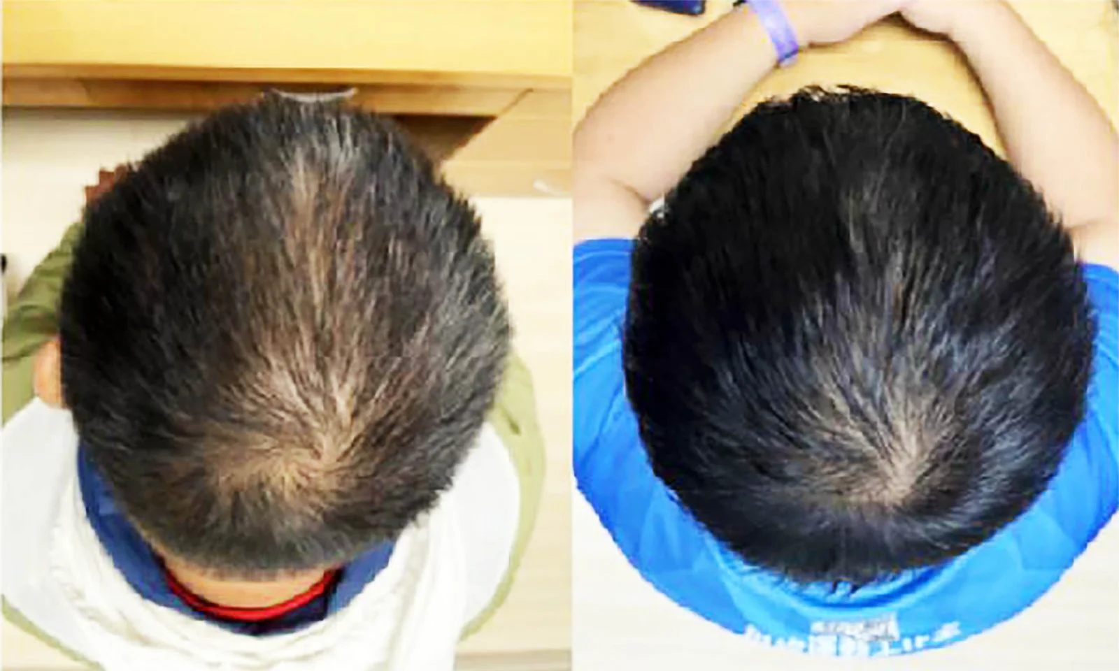 Plant-derived serum prompts rapid hair regrowth in early trial