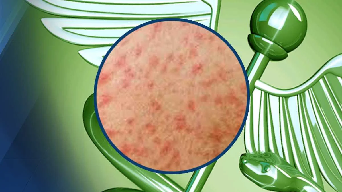 Measles Confirmed in Milwaukee Resident, Health Department Reports