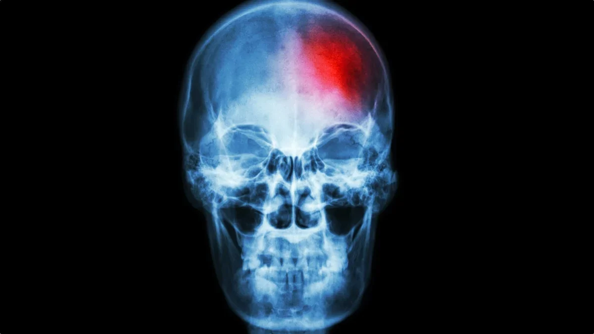 Skull Bone Marrow Linked to Chronic Pain Through Immune Signaling