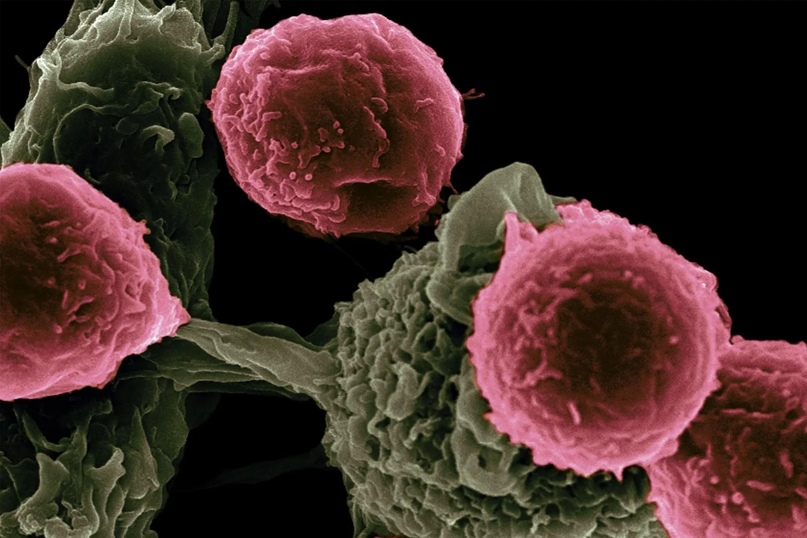 CAR-T Reset Reboots Immune System to Heal Three Autoimmune Diseases